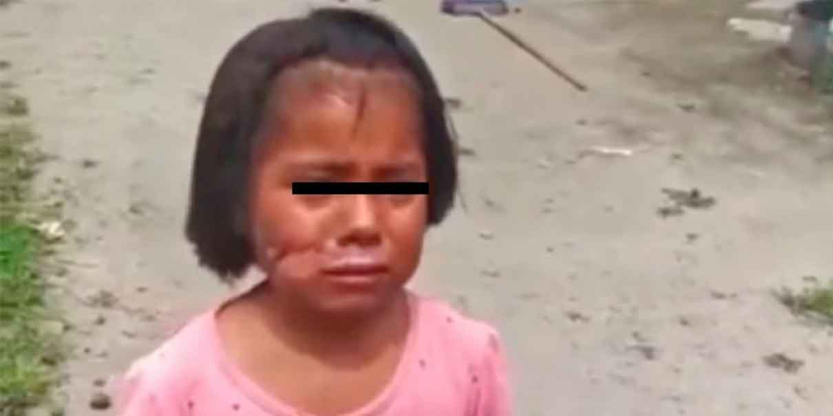 Bajo resguardo del DIF Puebla joven quemada por su abuela