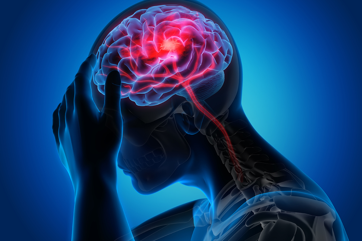 Infarto cerebral: cuando la atención inmediata salva la vida