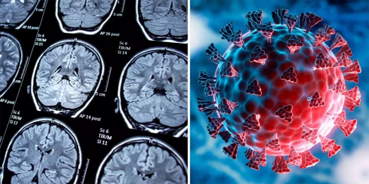 cerebro covid 19