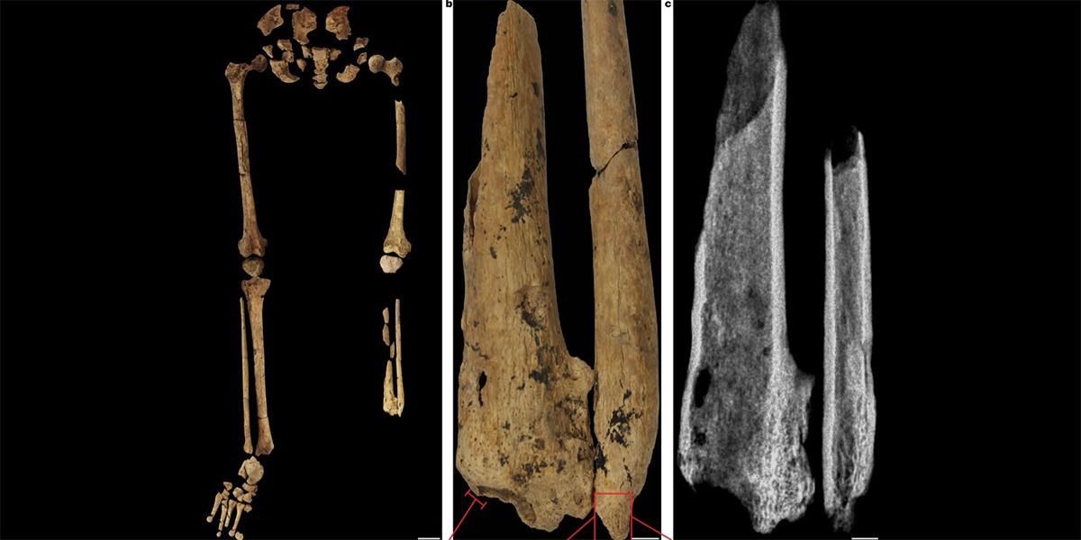La primera amputación quirúrgica fue realizada con éxito hace 31,000 años: investigación