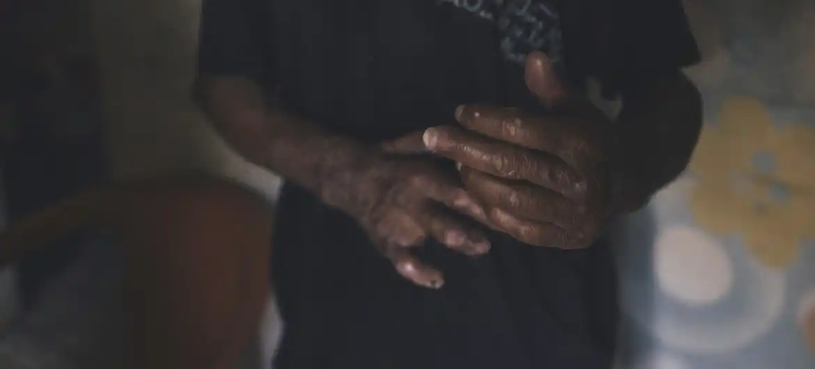 Hanseniasis: qué es y por qué se le conmemora