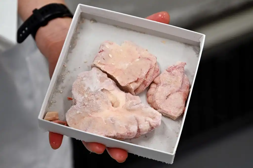 Colección de cerebros de enfermos mentales estremece a la ciencia