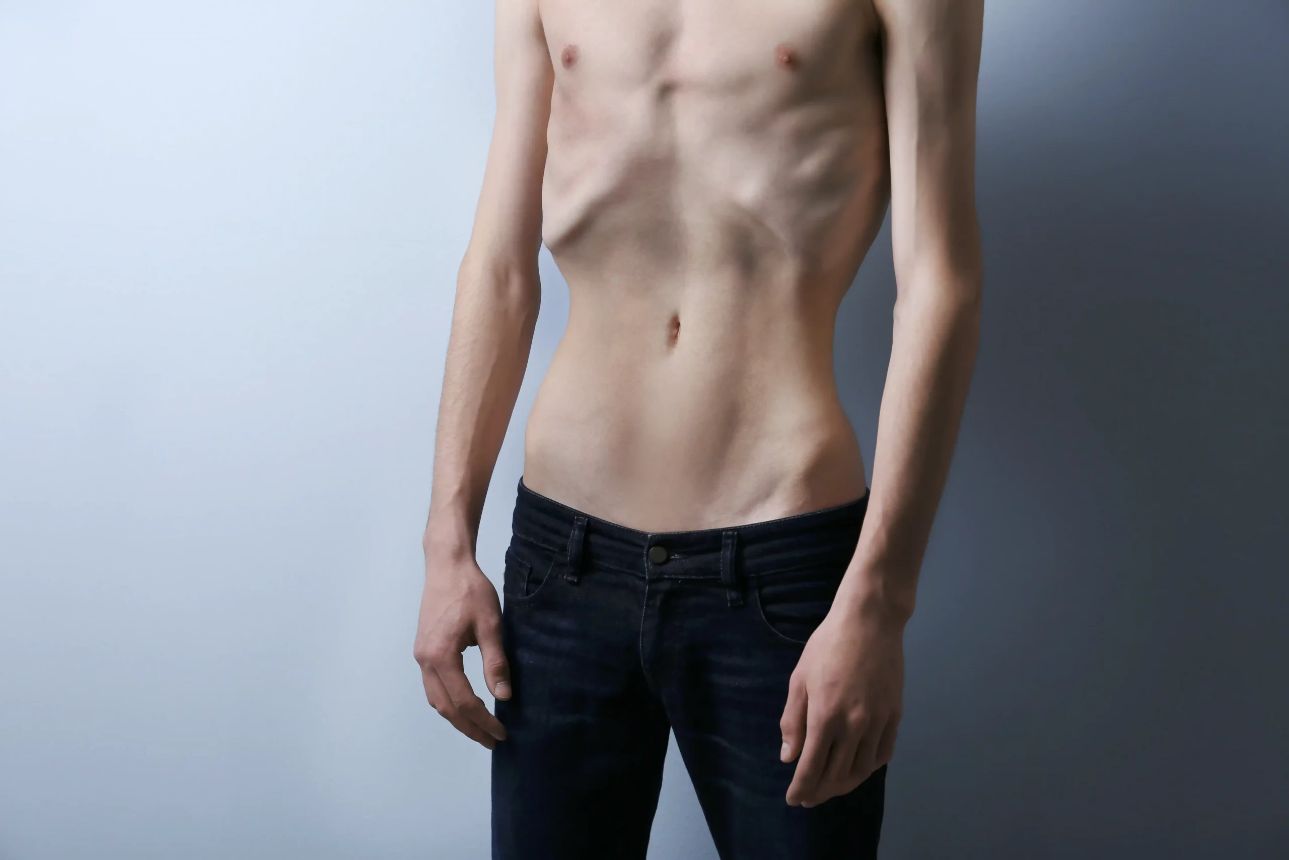 Anorexia nerviosa