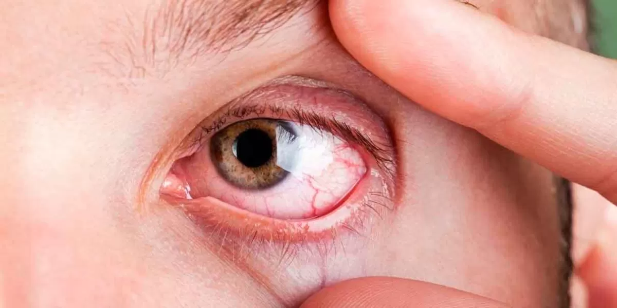 Rinitis, Laringitis y Conjuntivitis, primeras enfermedades por ceniza volcánica