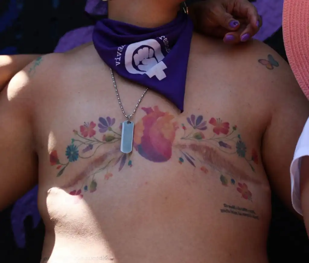 cáncer de mama tratamiento