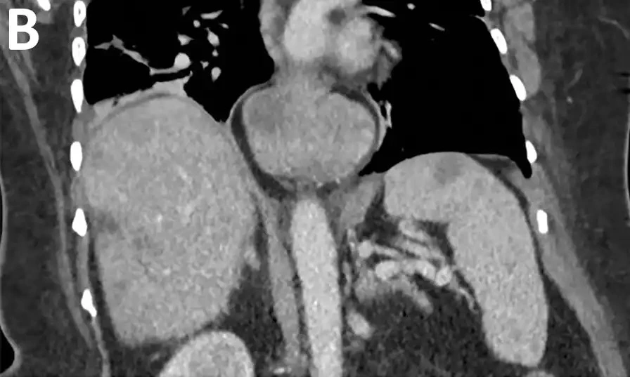 Médicos encuentran una lombriz viva en el cerebro de una mujer