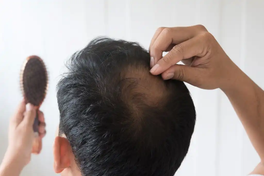 Alopecia hombres