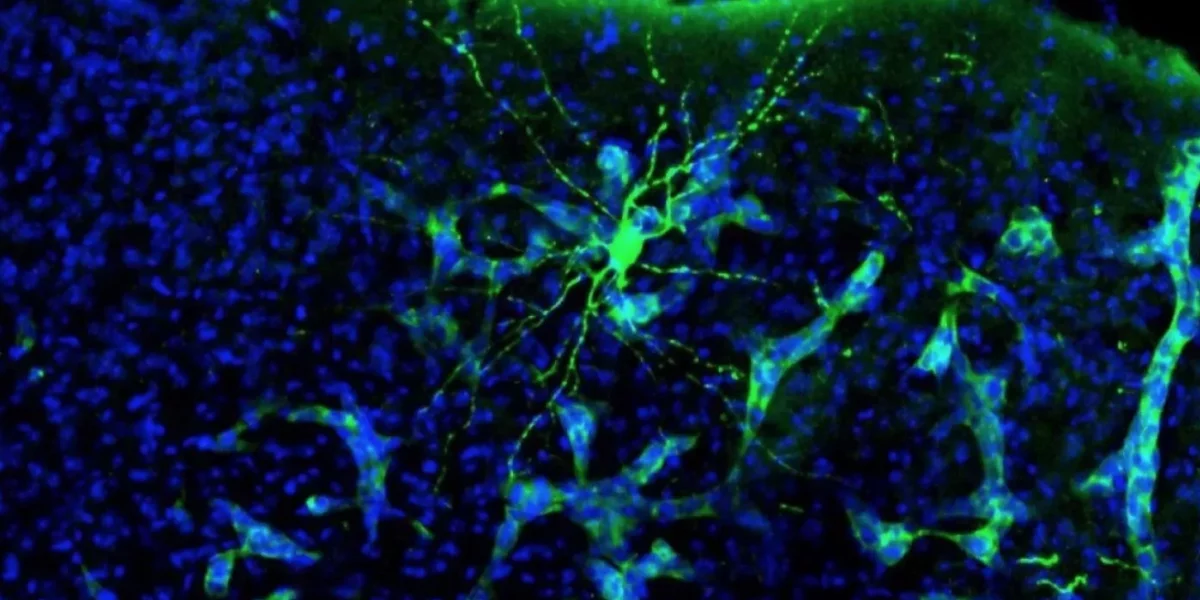 tumores cerebrales