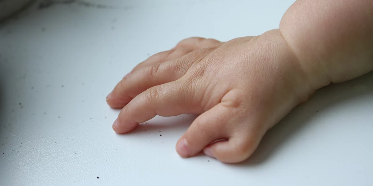 polidactilia