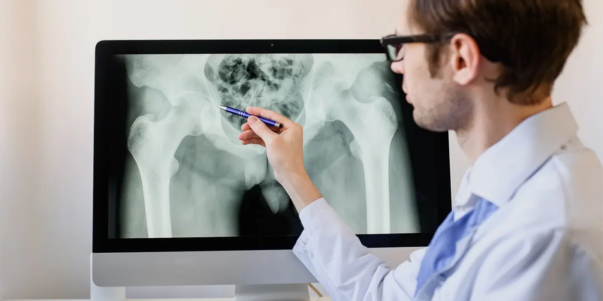 osteoporosis
