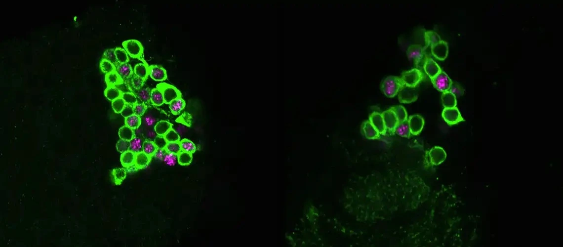 Parkinson neuronas
