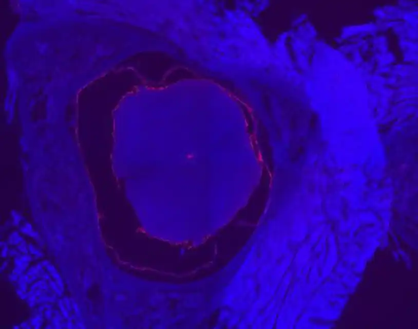 Nanopartículas cáncer cerebral