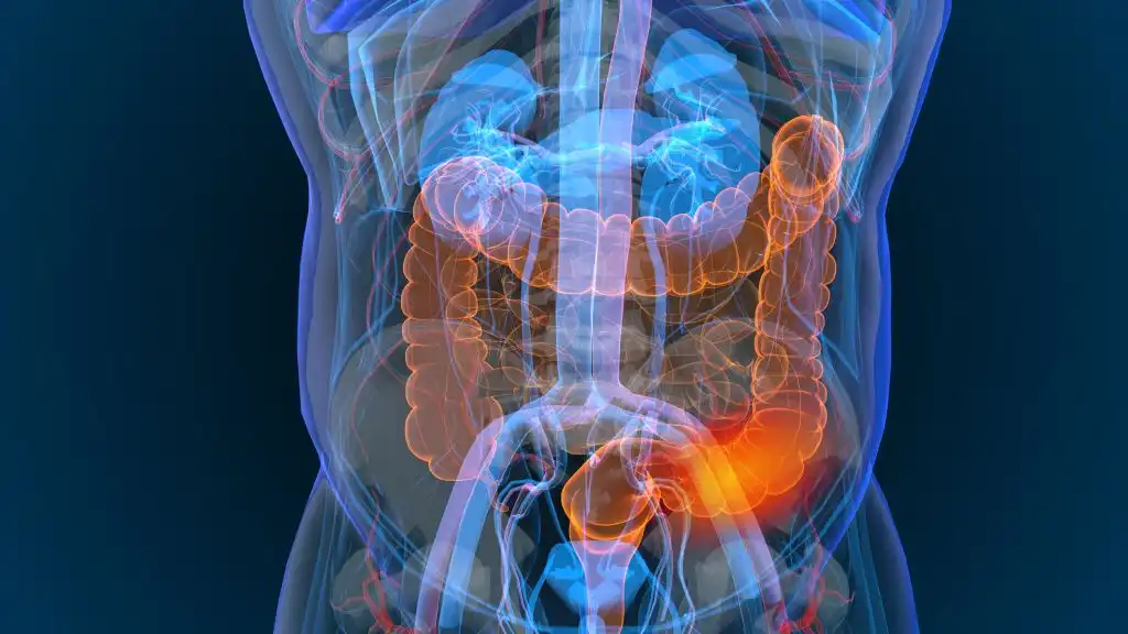 Cáncer de colon