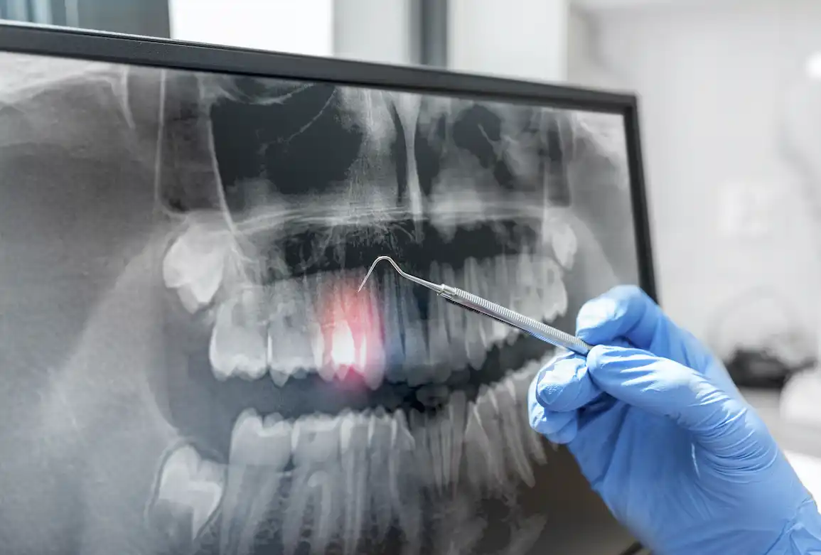 Pulpitis, periodontitis y trauma dental son algunas de las causas del dolor de dientes