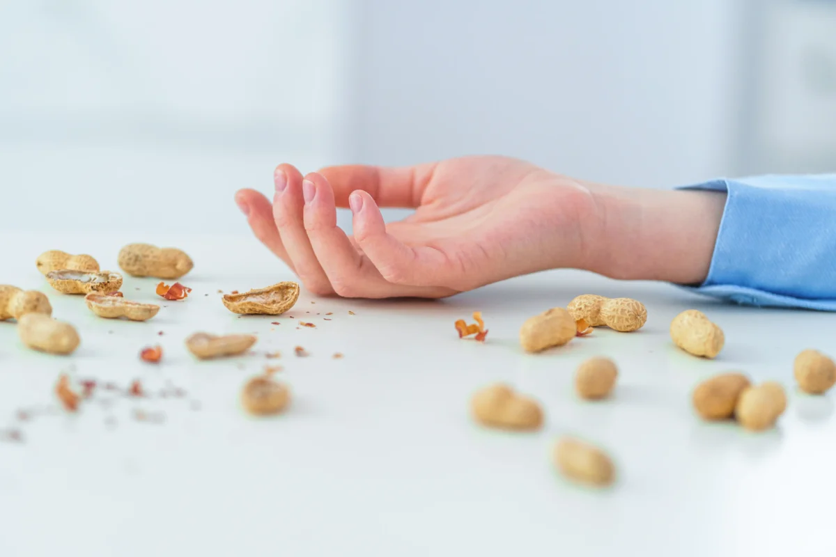 alergias alimentarias