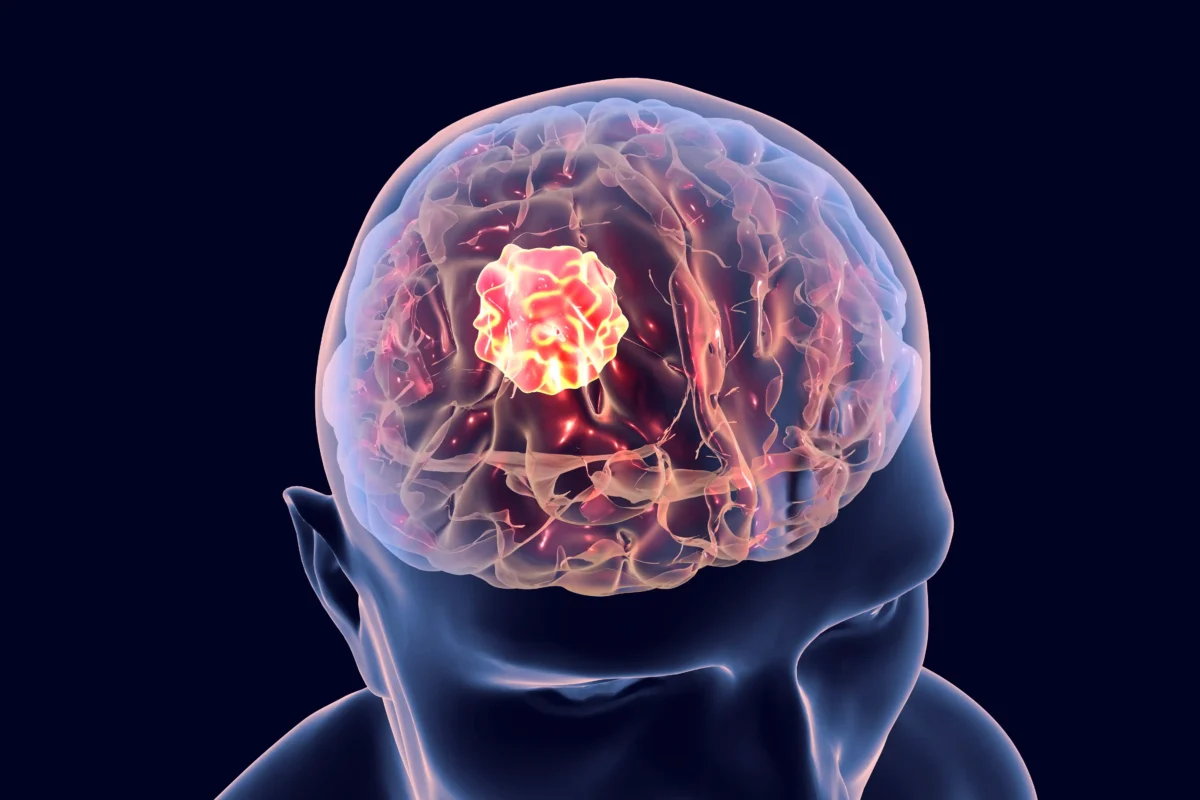 cáncer cerebral
