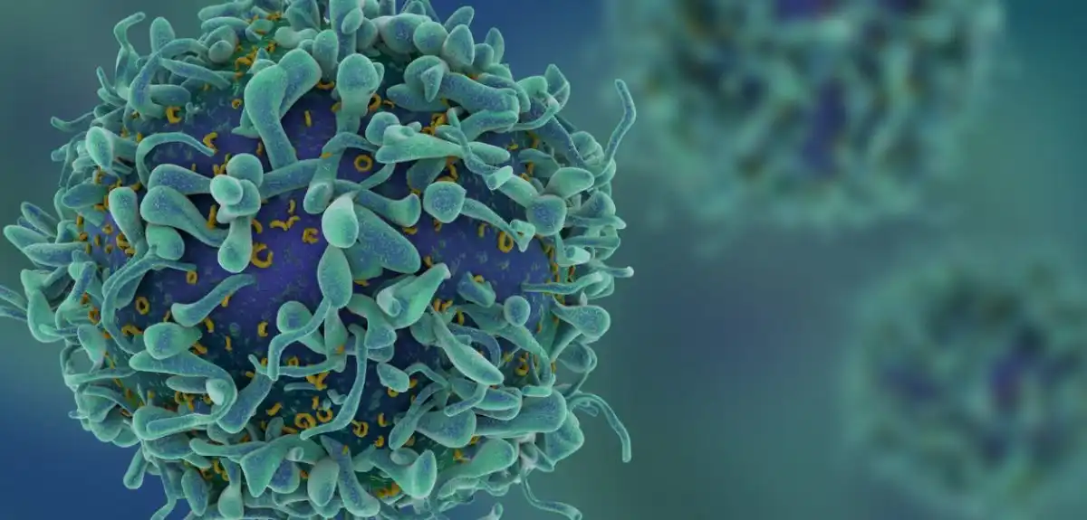 Cáncer de próstata Inteligencia Artificial