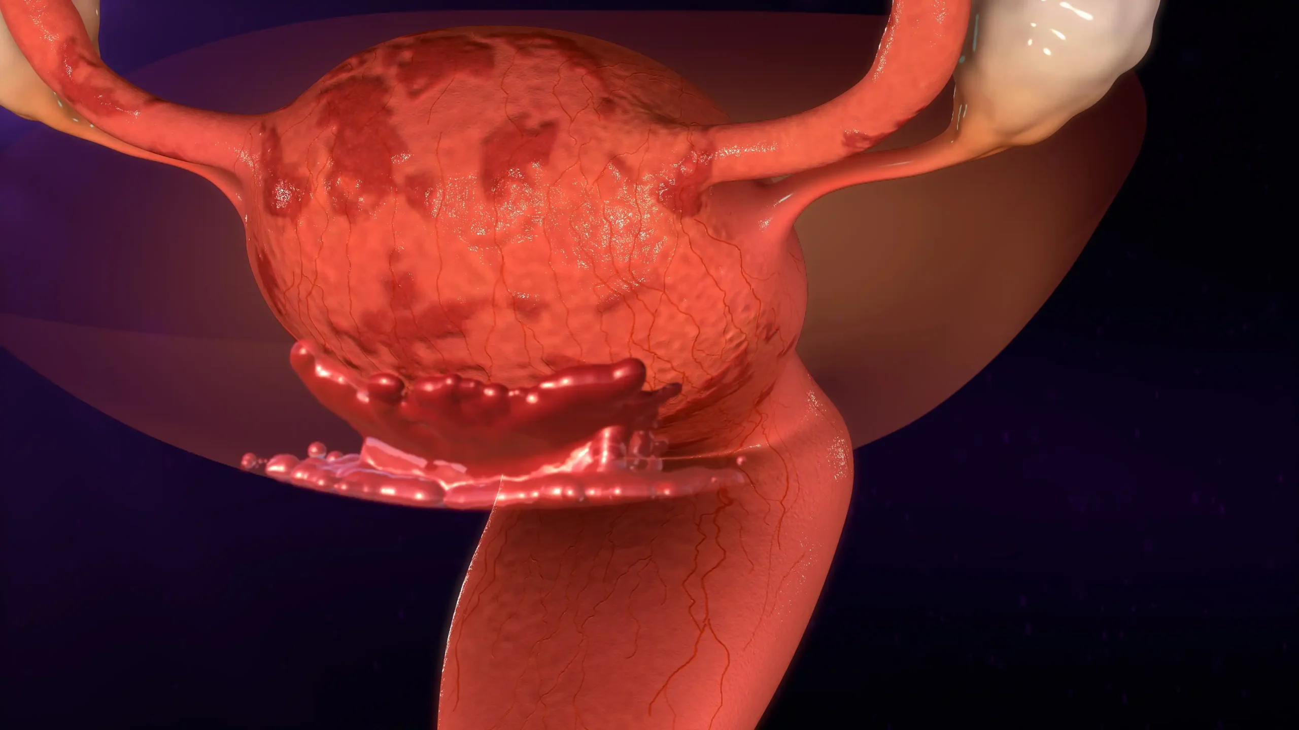Endometriosis dolor