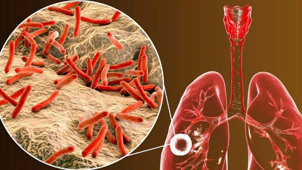 La Secretaría de Salud de Guanajuato renueva su compromiso en la lucha contra la tuberculosis.