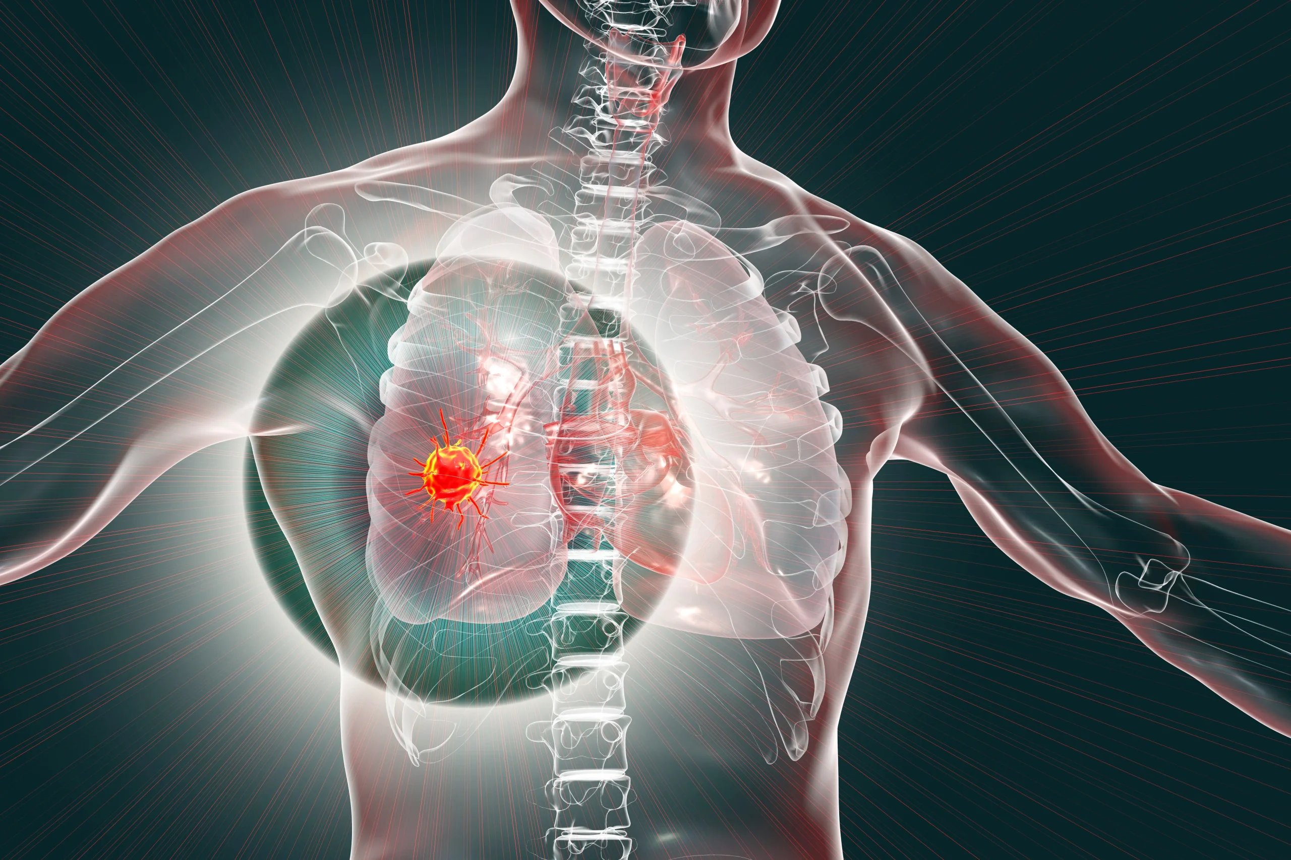 Este medicamento reduce la progresión del cáncer de pulmón y mejora la supervivencia