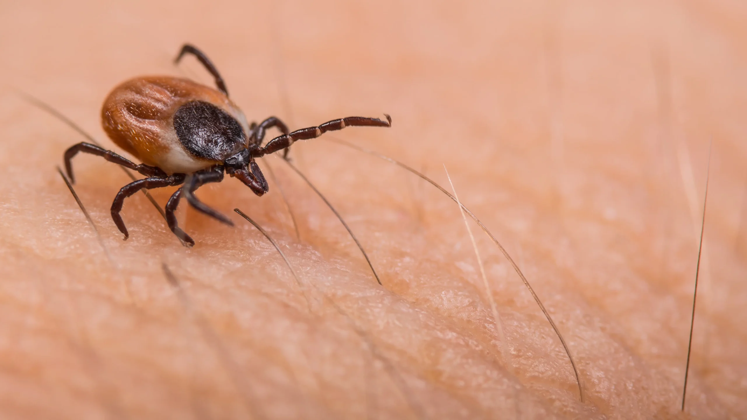 babesiosis