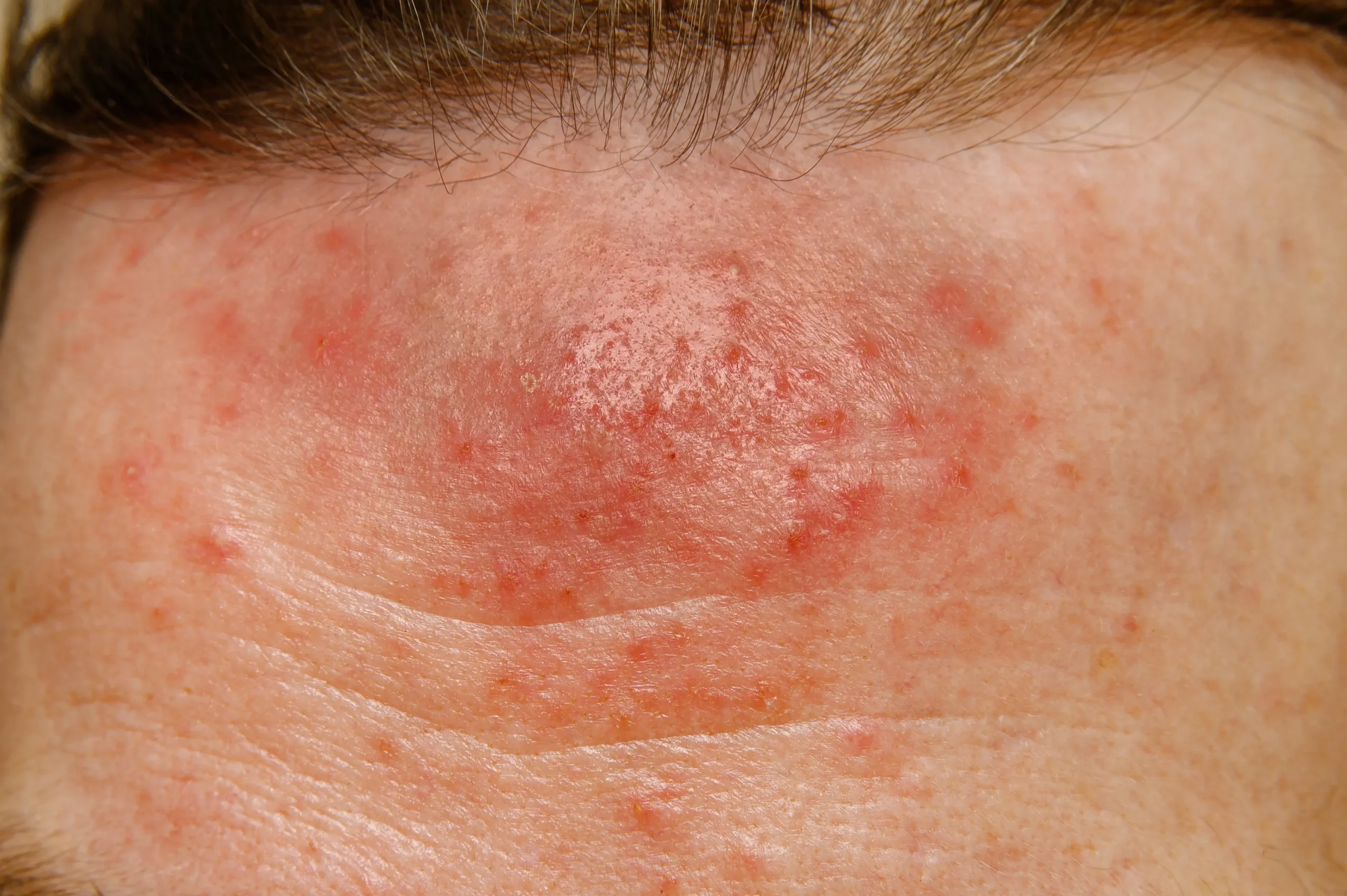Demodex, el ácaro que vive en la piel y provoca inflamación y problemas oculares