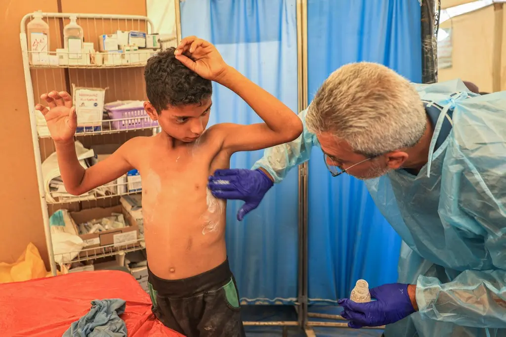 Sarna Piojos Gaza