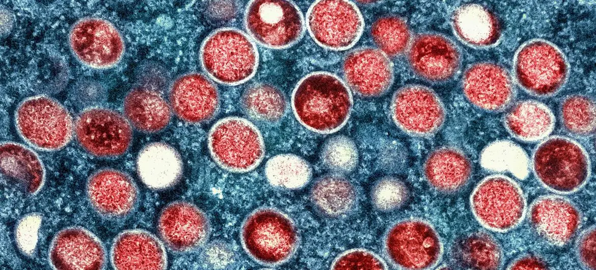 Alerta mundial por mpox: síntomas y cómo identificar la enfermedad
