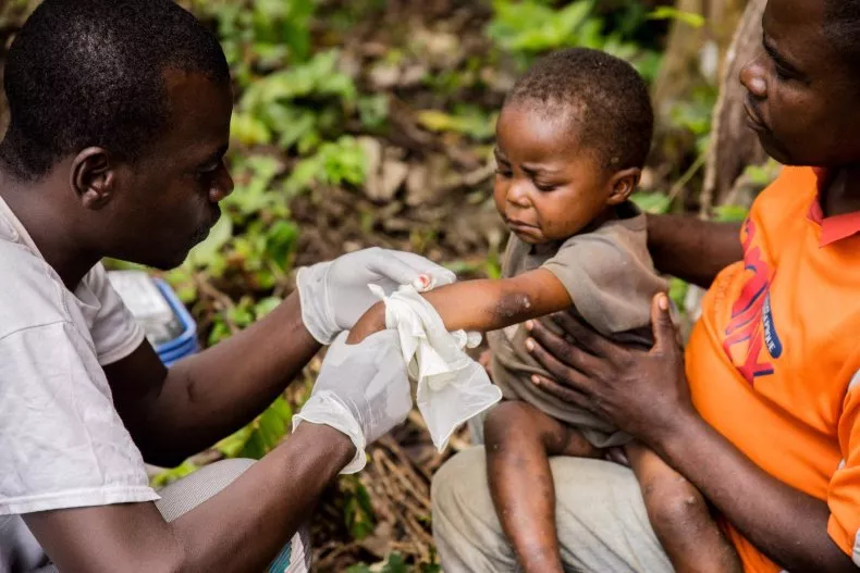 Las personas jóvenes son más vulnerables a mpox, advierten los epidemiólogos
