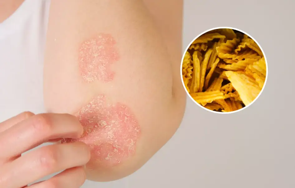 alimentos ultraprocesados psoriasis