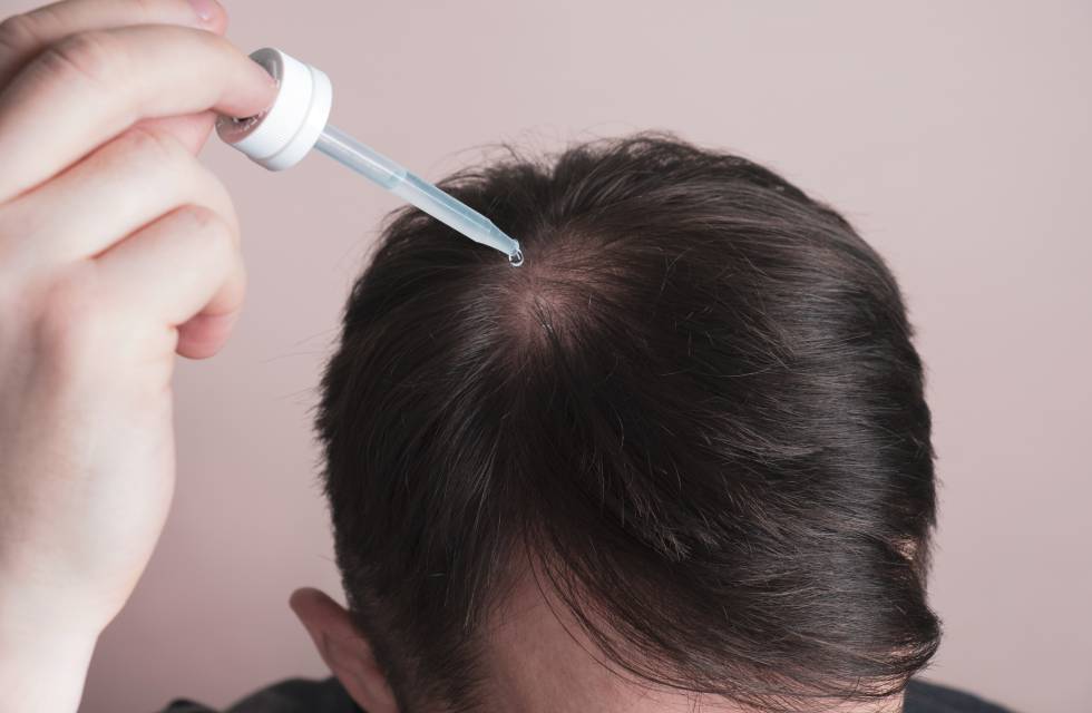 Minoxidil es una sustancia que se usa para combatir la perdida de pelo.