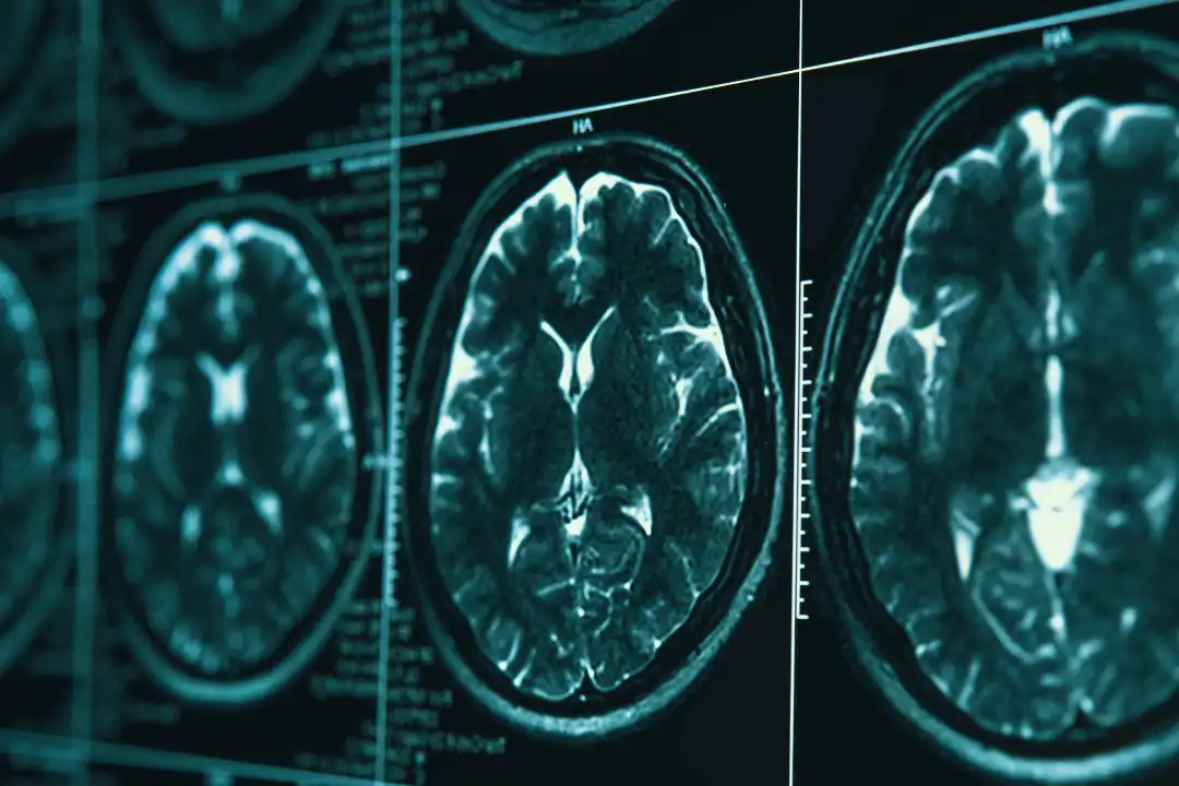 Alzheimer: los 10 signos tempranos que no debes ignorar, según expertos