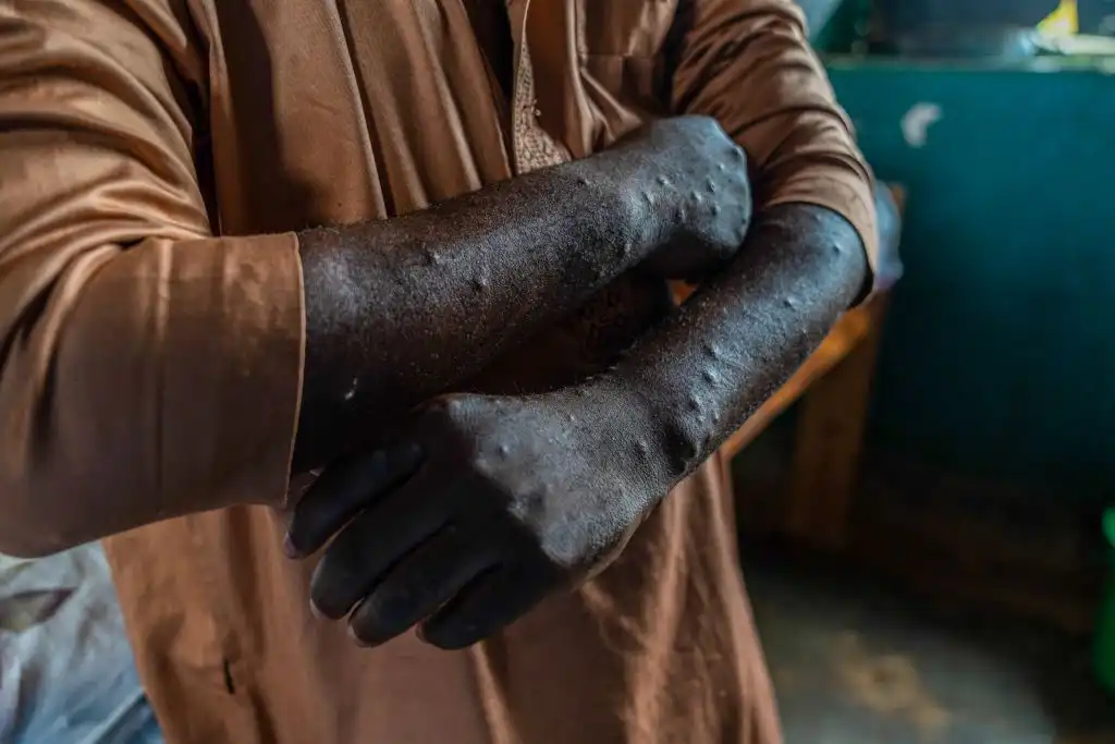 Mpox no ha desaparecido: la OMS mantiene alerta internacional