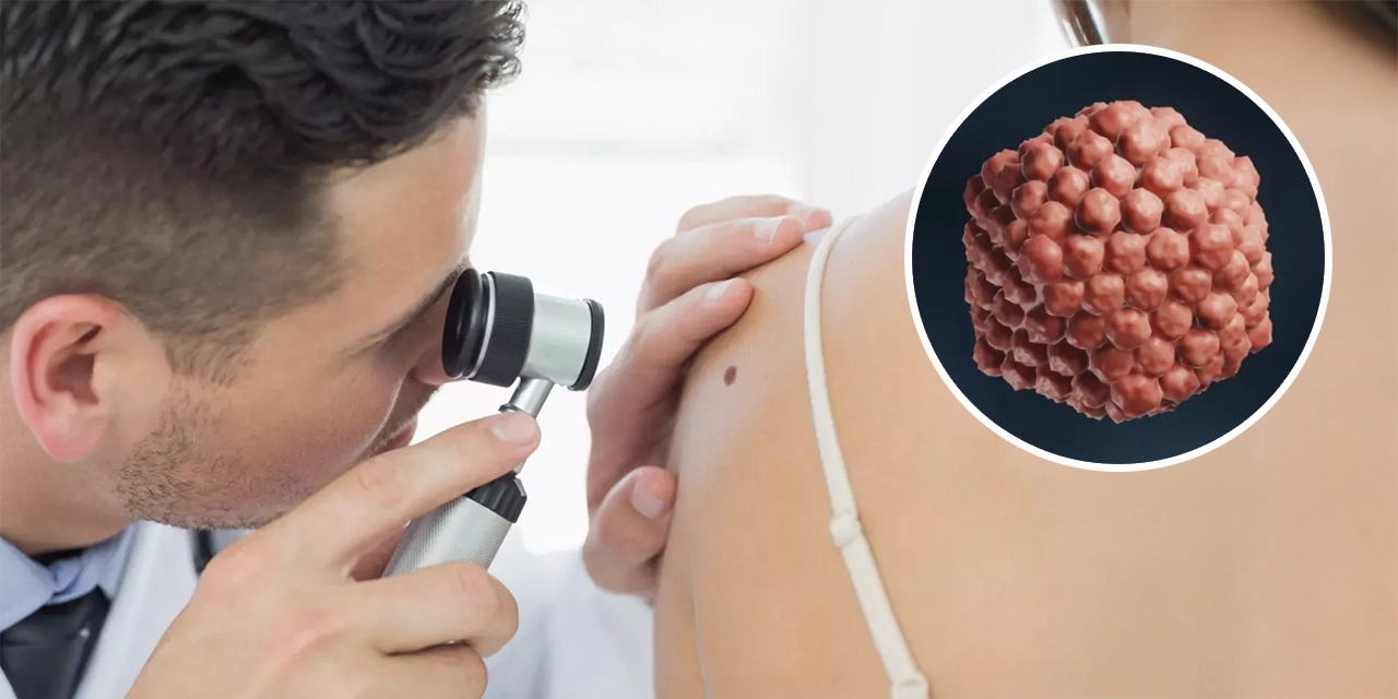 ¿El virus del herpes cómo ayuda a tratar el cáncer avanzado? Esto responde la ciencia