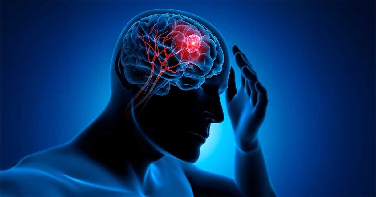 tumores cerebrales