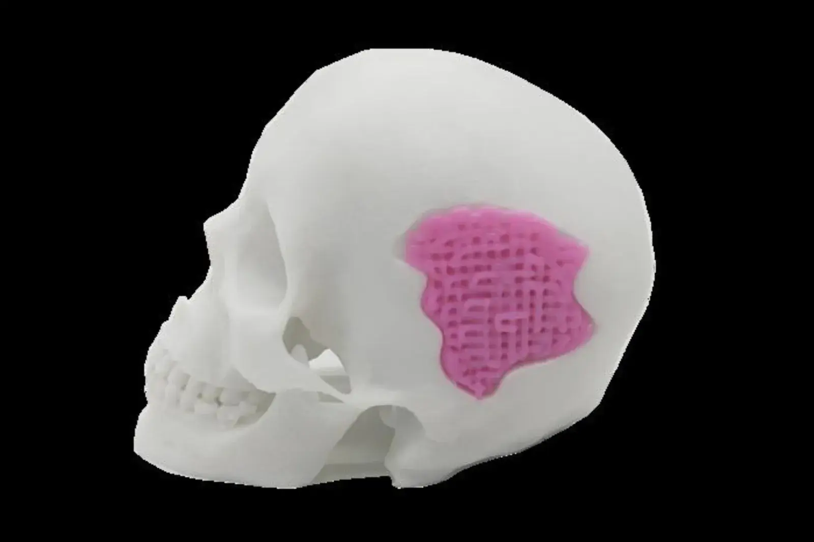 Científicos logran imprimir vidrio en 3D que favorece el crecimiento de huesos