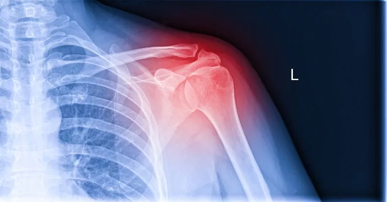 La ciencia convierte una pistola de pegamento en un dispositivo capaz de reparar huesos rotos