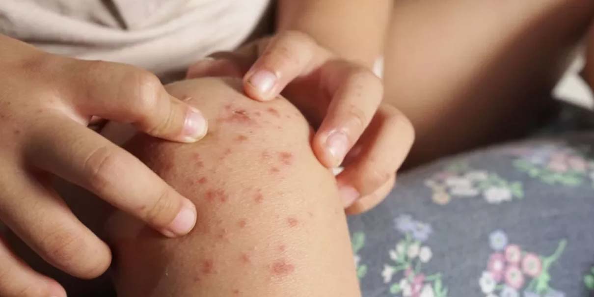 Brote de coxsackie obliga a cerrar preescolar en Izúcar de Matamoros