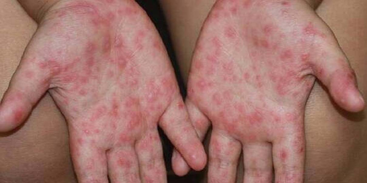 Brote de virus Coxsackie obliga a suspender clases en escuelas de Puebla