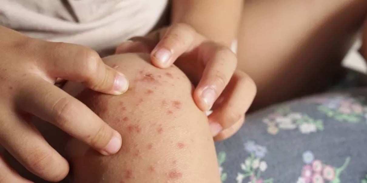 Puebla: SEP confirma casos de virus Coxsackie en alumnos de Chalchicomula y Tlachichuca