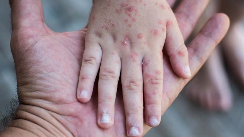 SEP Puebla confirma contagios de virus Coxsackie en escuelas