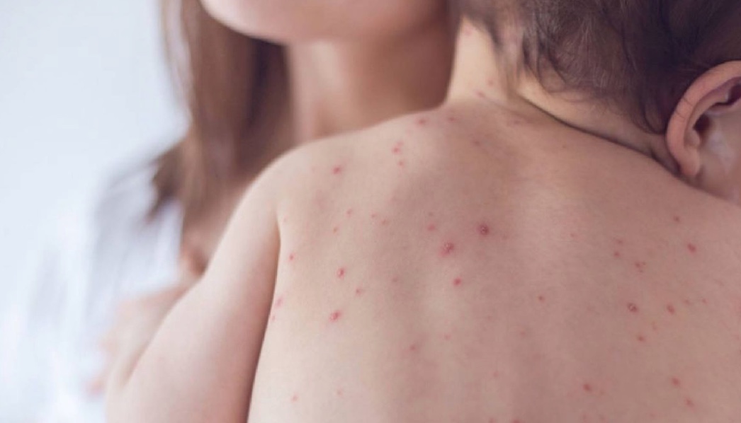 Guanajuato reporta hasta 40 casos activos de varicela; llaman a no enviar niños enfermos a clases