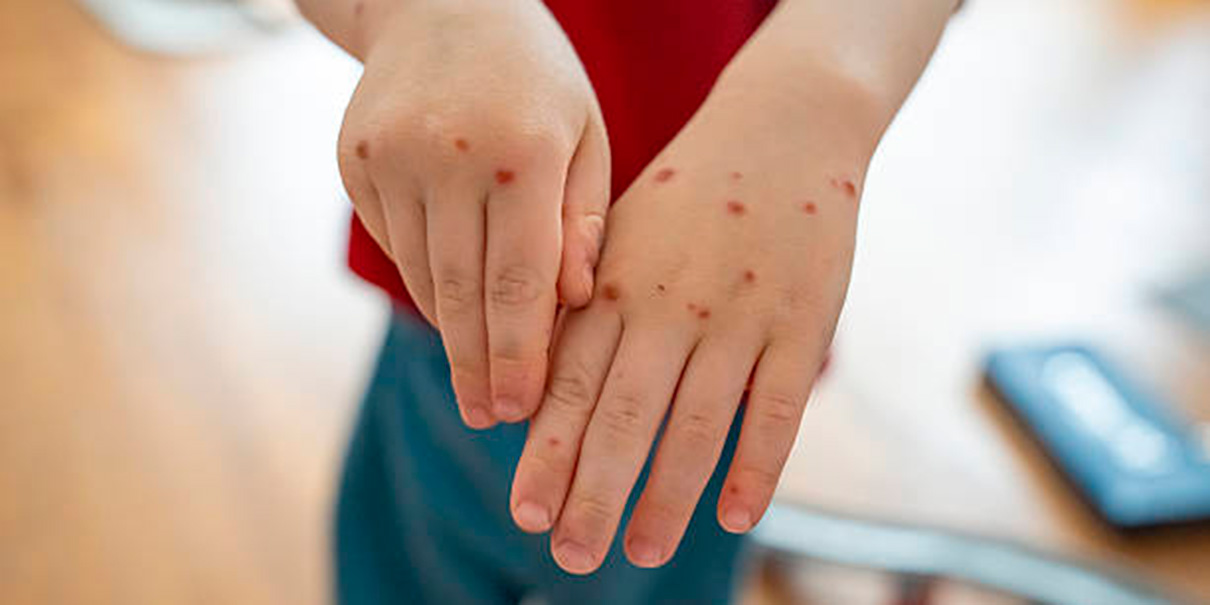 Alerta sanitaria en Ciudad Serdán por brote de virus Coxsackie