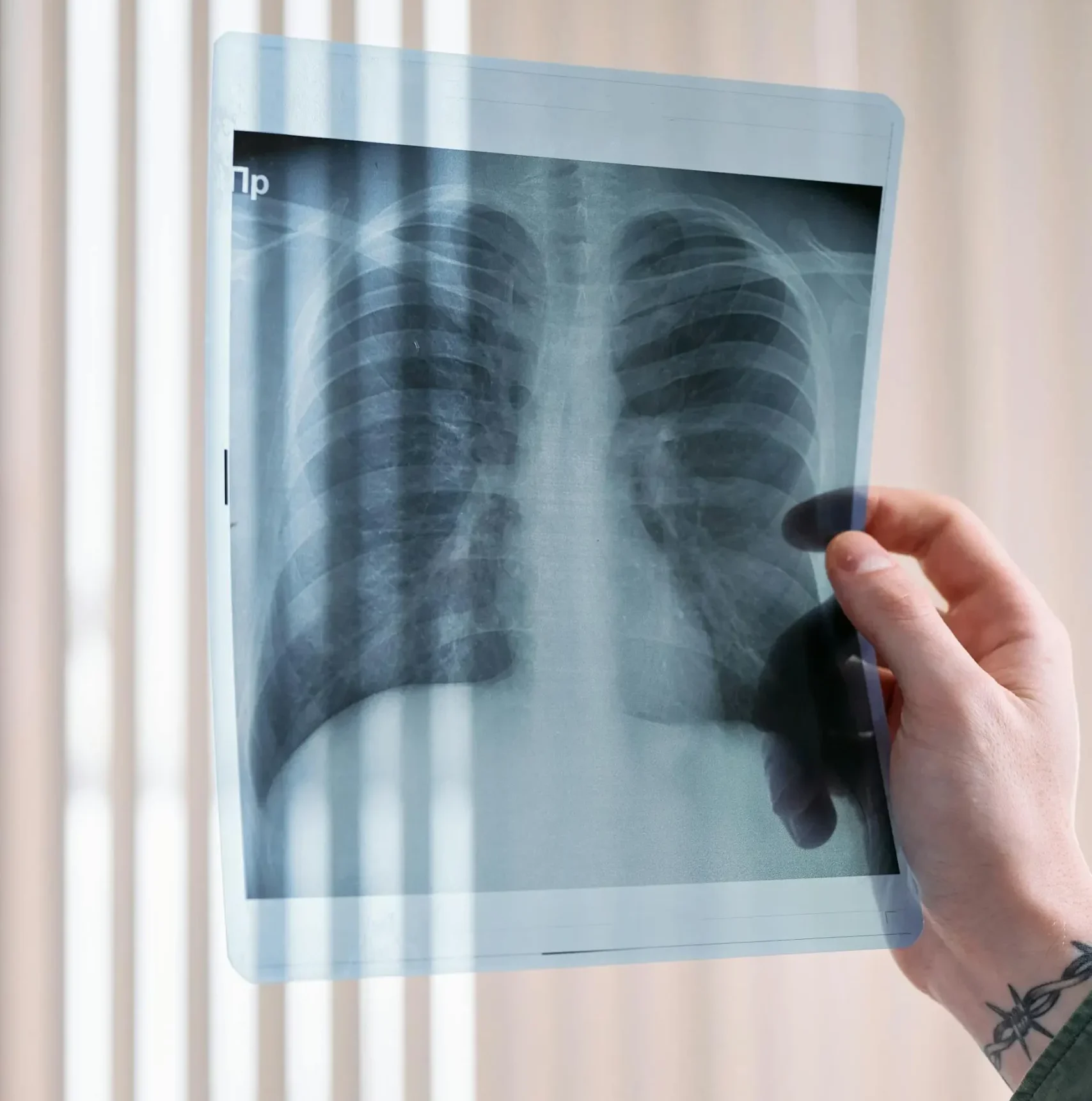 ¿Qué es la tuberculosis? enfermedad endémica que pega a más de 100 hidrocálidos