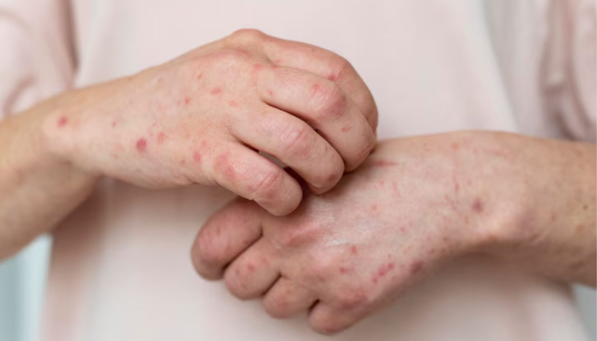 ISSEA reporta 20 casos de sarampión; descarta riesgo por la FNSM