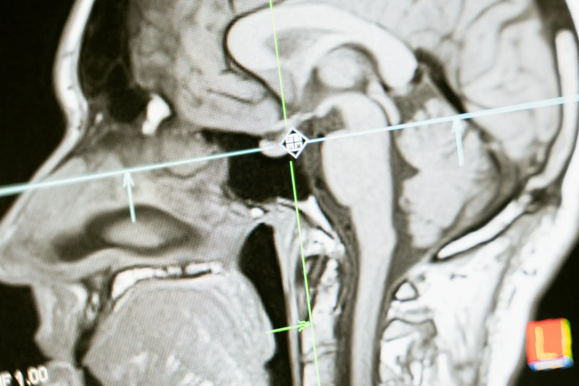 Esclerosis múltiple: las señales de una enfermedad que hace que el cuerpo se ataque a sí mismo