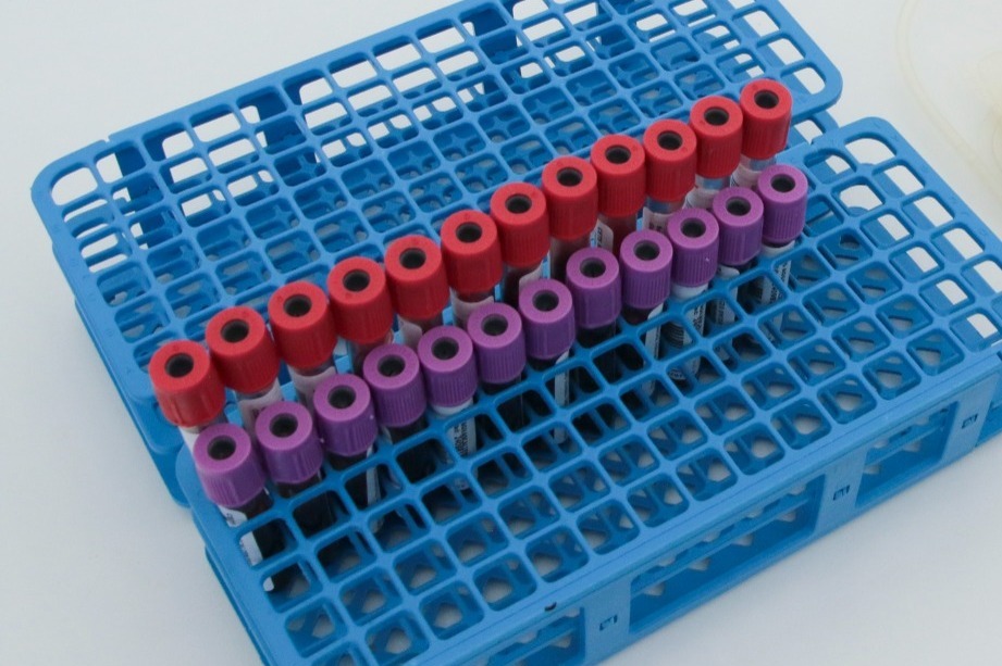 Impulsa UAA pruebas gratuitas para detectar enfermedad renal antes de que avance